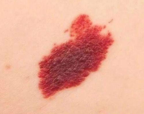 鹳吻痕是一种红色或者粉红色的斑块,由于毛细血管聚集在皮肤表面