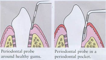 每年一次咬合翼片,检查后牙邻面早期龋齿.牙就没坏过,那就两年一次.