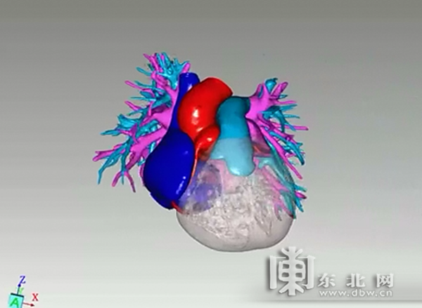 拓影系统混合现实手术导航下,患儿心脏三维解剖影像.