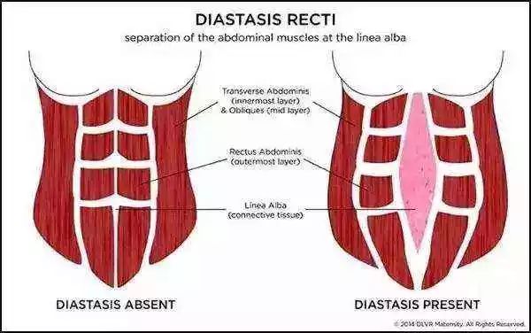所以腹横肌的作用,不仅是束腰,还能避免产后腹直肌分离