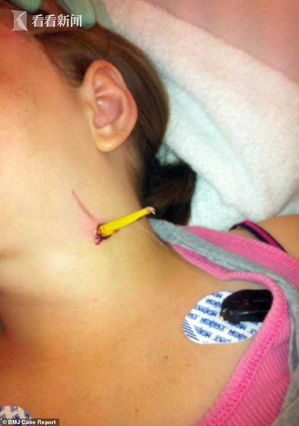 加拿大女孩被铅笔扎进颈动脉 手术3年后无任何后遗症