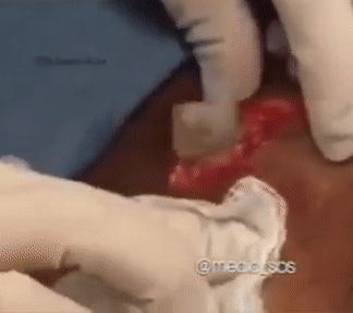 看挤黑头视频是什么感觉?有人恶心有人爽,有人甚至睡着了?