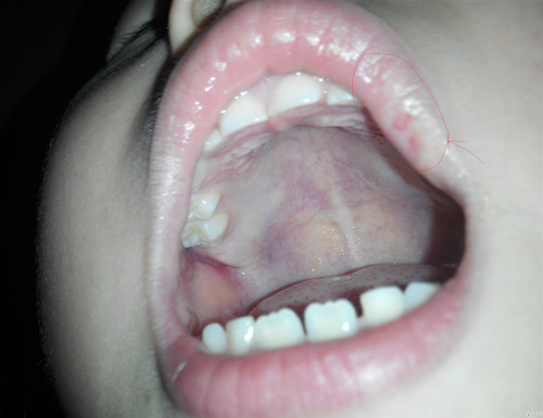 2,口腔海绵状血管瘤:由衬有内皮细胞的血窦及腔隙网状血管所组成.