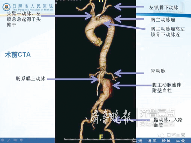 市人民医院开展日照市首例胸腹主动脉瘤联合手术