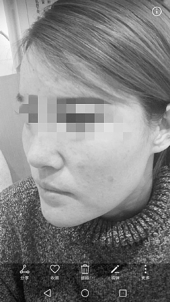 手术后脸上起痘,鼻子红肿.