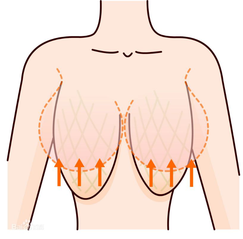 乳房下垂危害正常生活,该如何恢复胸部挺拔?