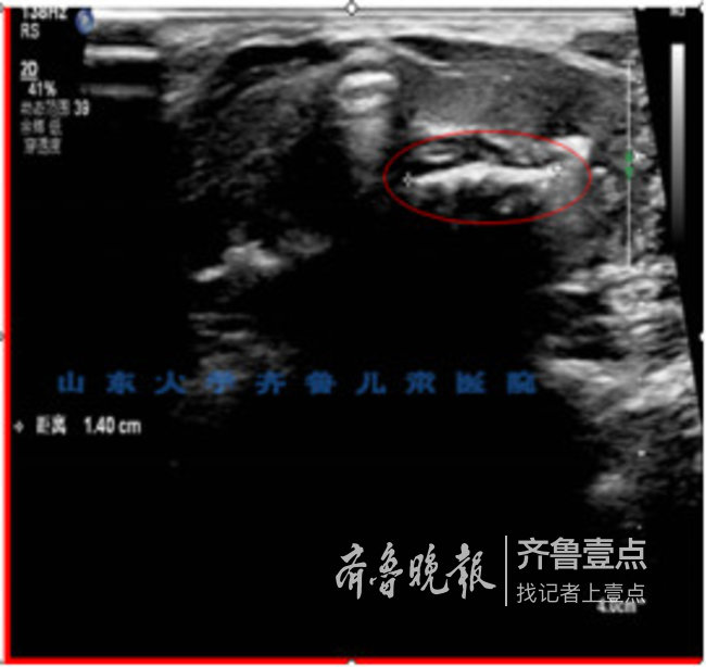 济南市儿童医院:宝宝是否误吞异物,可先做超声检查