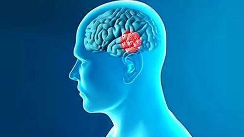 帕金森患者福音:脑起搏器微创术 省千医设绿色