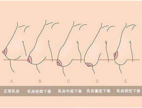 拒绝术后留疤,从不切开组织解决乳房下垂开始