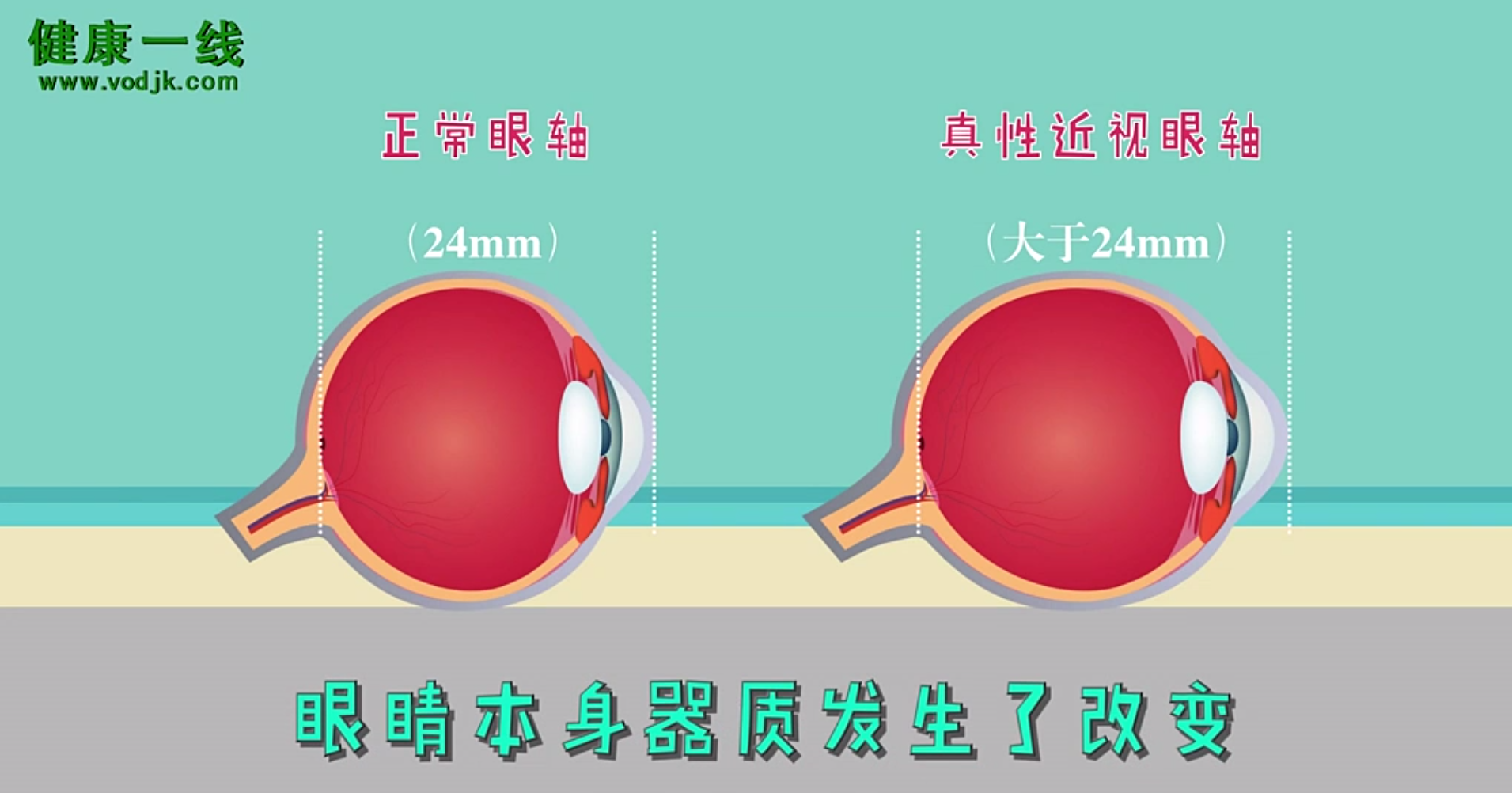 怎样辨别孩子是假性还是真性近视?