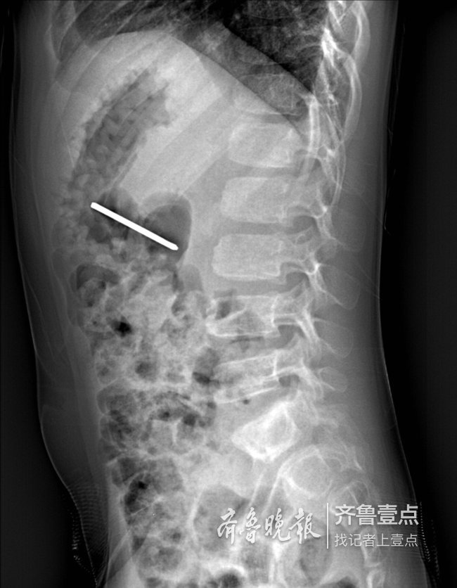 泰安一6岁男孩误吞5cm钢针 胃镜巧取免开腹之痛
