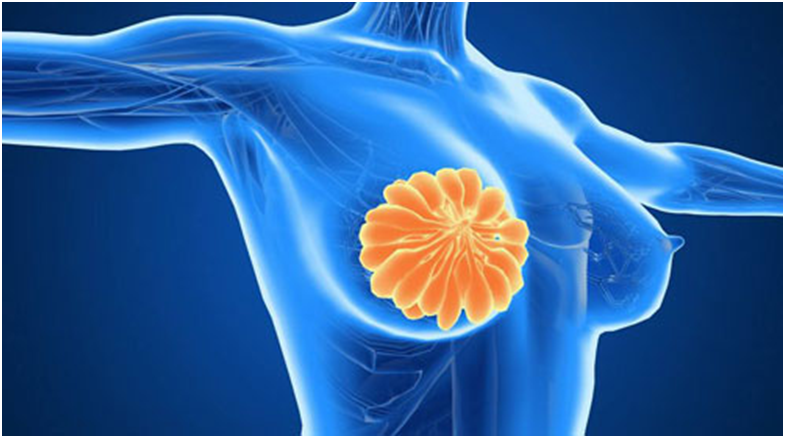 女性乳房肥大的成因及乳房缩小术如何选择的研究进展