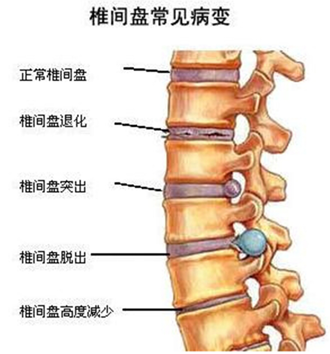 医聊室三维电脑牵引治疗腰椎间盘突出