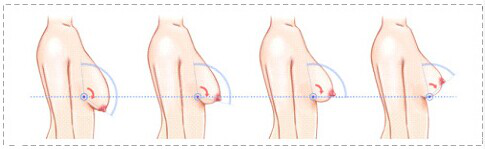 关注巨乳缩小手术的可能性,用切实际的方式解决难题
