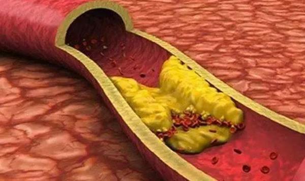 别再盲目"清血管"了,这几招比吃木耳管用!