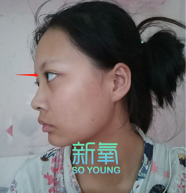 除了眼球突出,妹纸五官上的bug就是鼻子,鼻骨略宽,所以