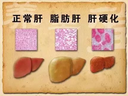 单纯性脂肪肝→脂肪性肝炎→肝纤维化→肝硬化→肝癌
