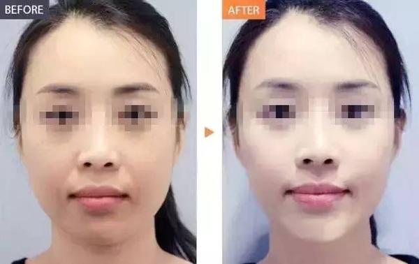 把水光针当日常保养,难怪皮肤这么好?