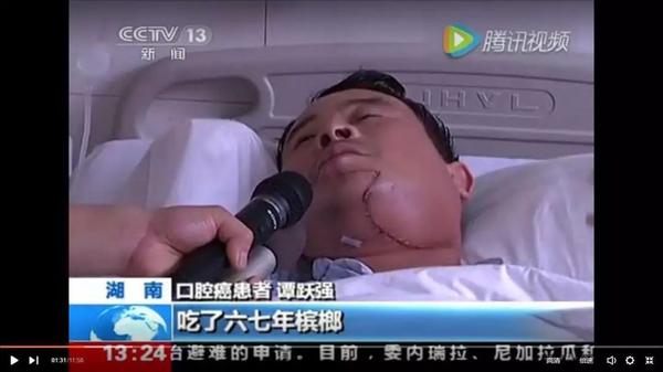 世界卫生组织也把槟榔果列为了一级致癌物.