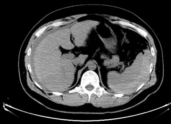 肝脏破裂ct图片图片