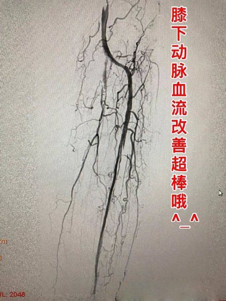 老人下肢動脈硬化閉塞怎麼辦?