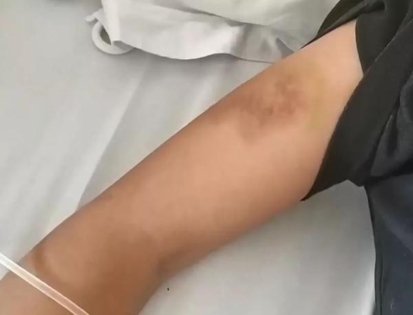 15岁女孩遛狗时被人用铁棍打伤?持棍者:母亲被狗咬伤了(视频)