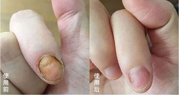 叔叔这下可放心了,拿回去用了两盒,指甲真的恢复了原来的光泽.