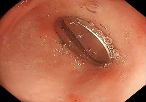 宝宝误吞纽扣电池,妈妈"小题大做"专业处置,医生竖大拇指夸赞