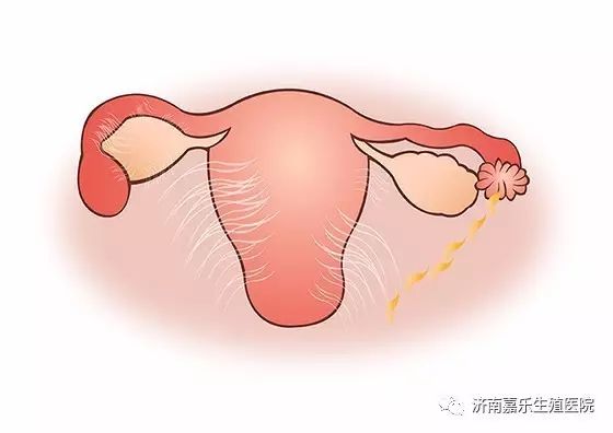 子宫腺肌症B超图片