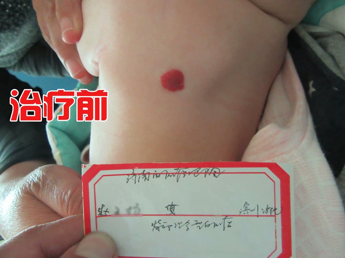 新生儿血管瘤会疼吗?这些问题宝妈必读