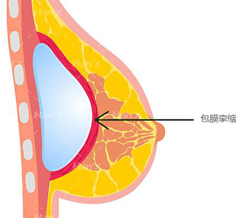 隆胸后遗症无解?安全的手术方式是最好的答案