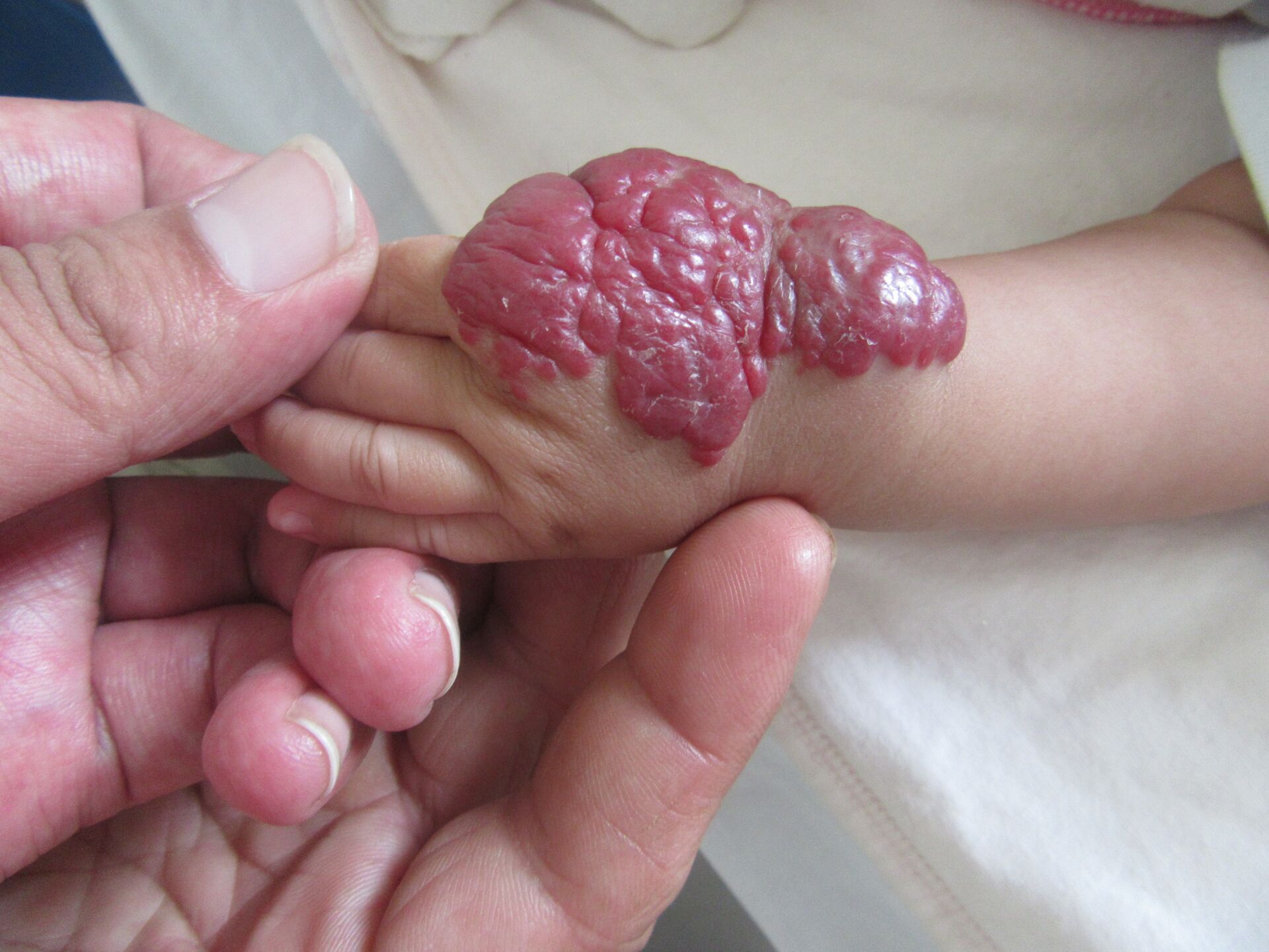 婴幼儿手部血管瘤,成因和症状一目了然!