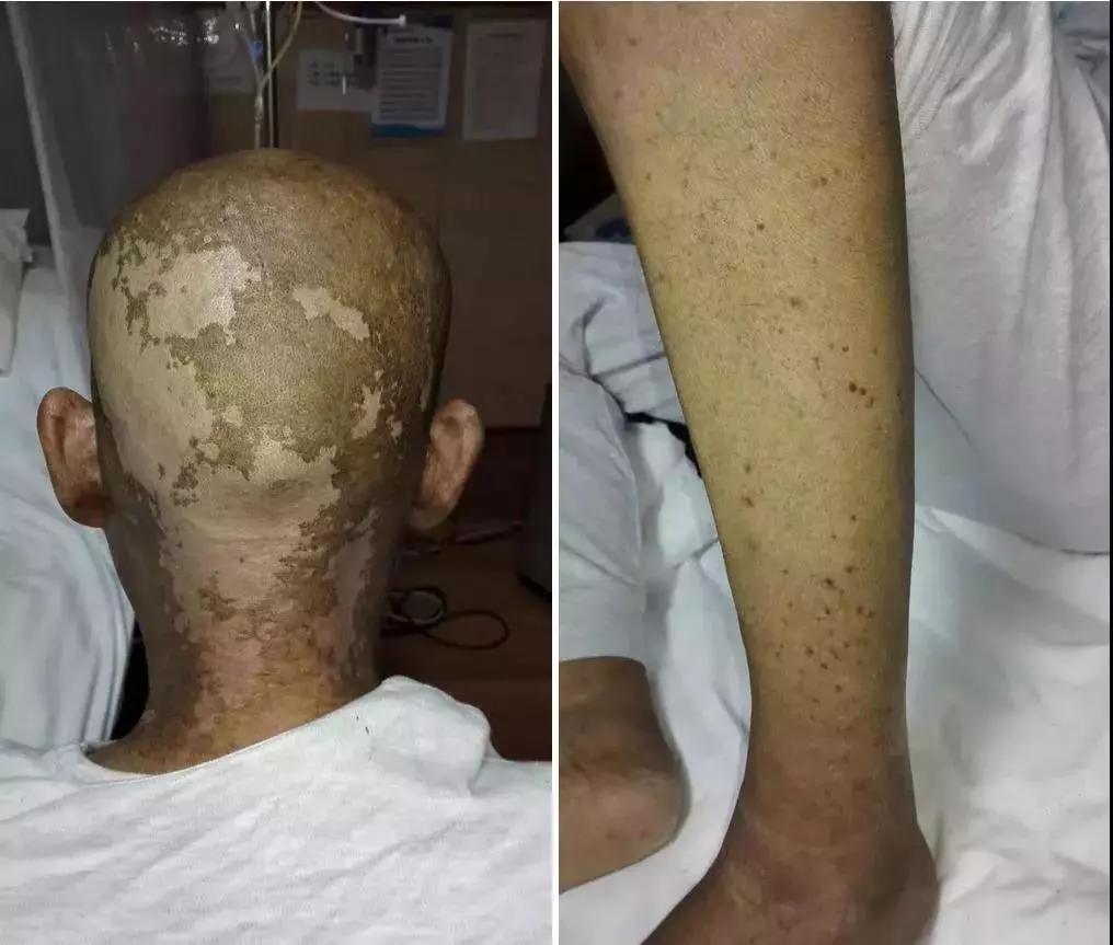 因皮肤排异,全身换了一层皮,全身布满出血点,瘦成皮包骨头:方某肠排拉