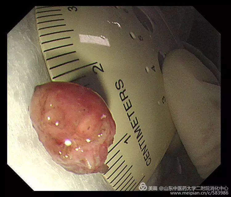 这名患者胃内已经有一个腺瘤发生了癌变,也通过胃镜完整切除,愈合良好