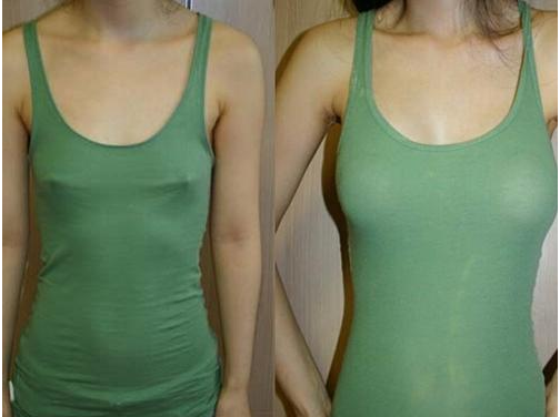 真正的两种隆胸方法,后遗症问题告诉你该如何选择