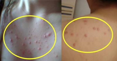 为什么后背会长痤疮?3个小妙招消除背部痤疮