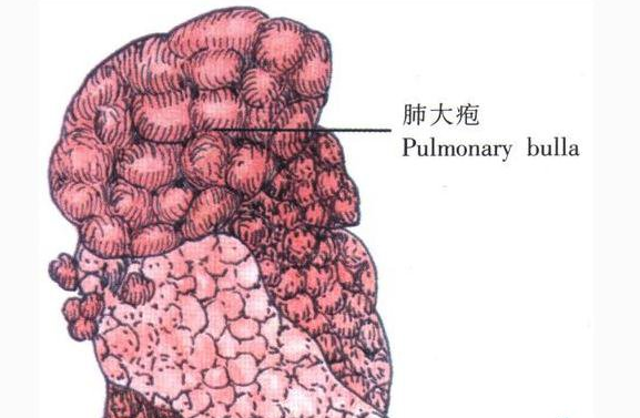 肺泡壁破裂,互相融合,在肺组织形成的含气囊腔