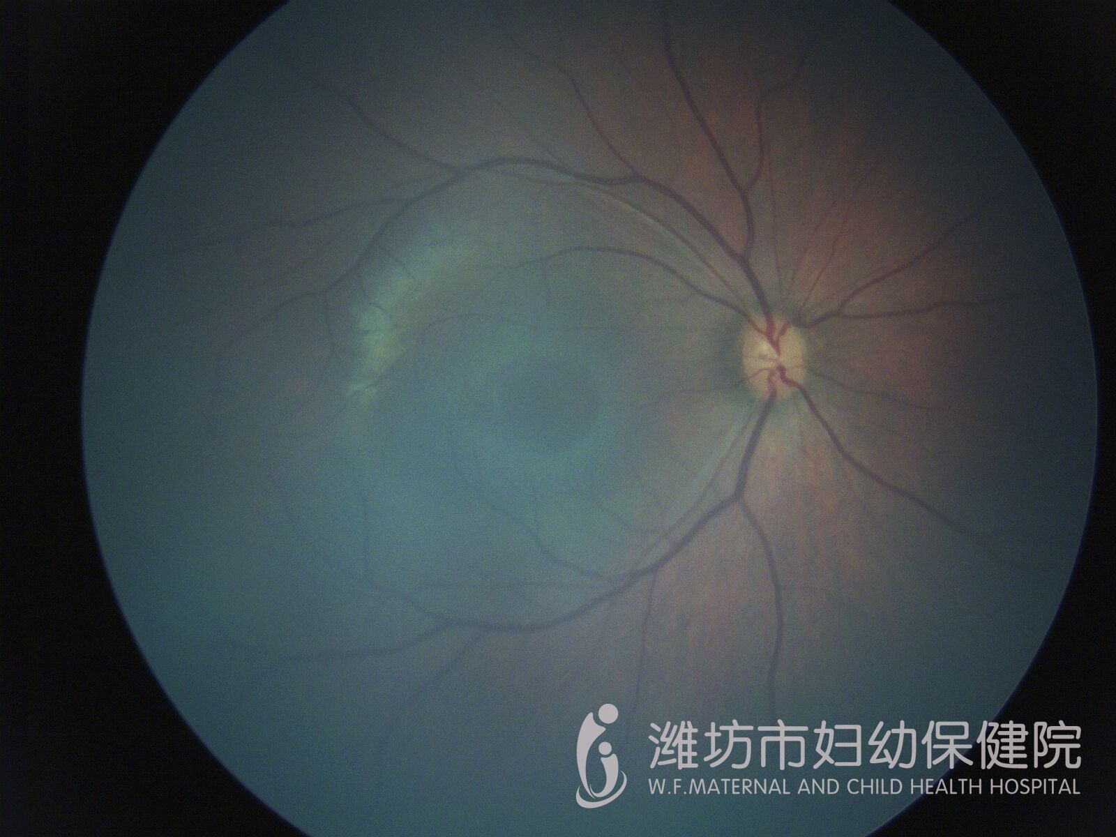 视网膜母细胞瘤不可怕  及早治疗,治愈率很高专家解疑2019年2月22日