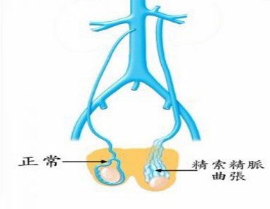 精索静脉曲张的症状有哪些表现