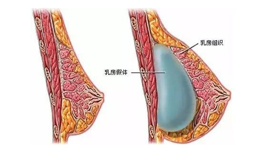 隆胸对身体巨大的伤害竟是因为这些?