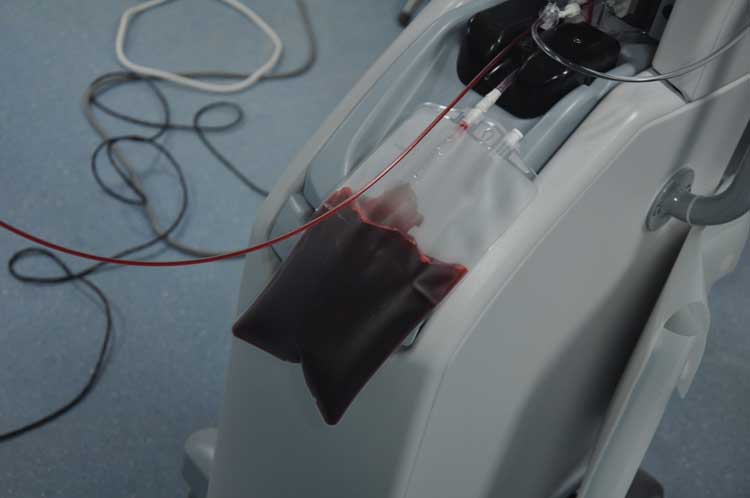 滨医附院黑科技:绘制血管地图按图索骥取血栓