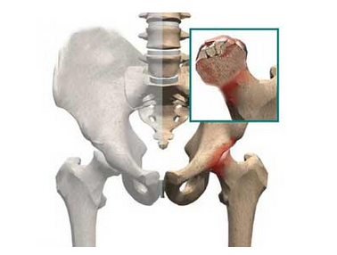 为什么股骨头会出现塌陷的现象