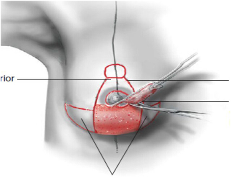 乳房手术全过程 悬吊图片