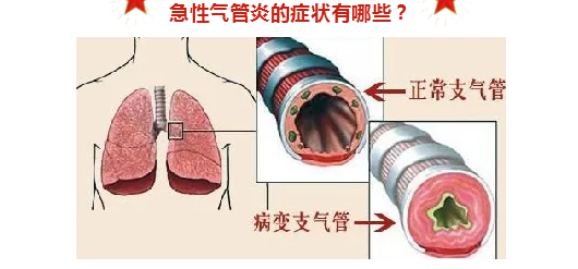 急慢性气管炎,症状并不相同!