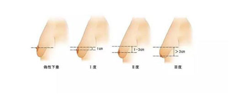 女性乳房下垂的病因机制和诊断,不切开方式治疗