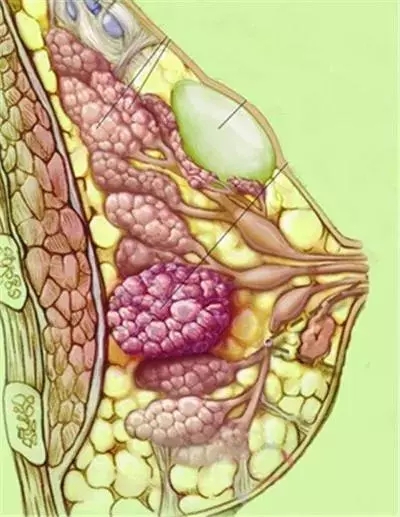 乳腺癌图片大全恶性图片