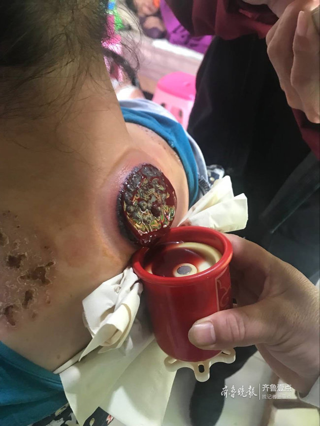 罐的方式治疗腰疼,每次治疗后脸色都很难看,拔罐后还留下了严重的伤口