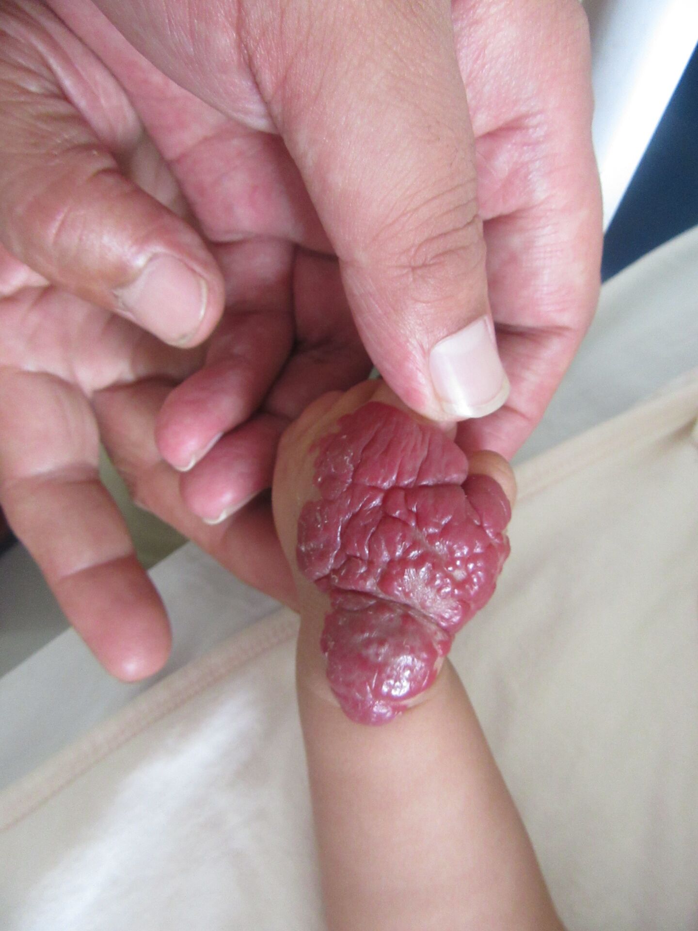 婴幼儿手部血管瘤,成因和症状一目了然!